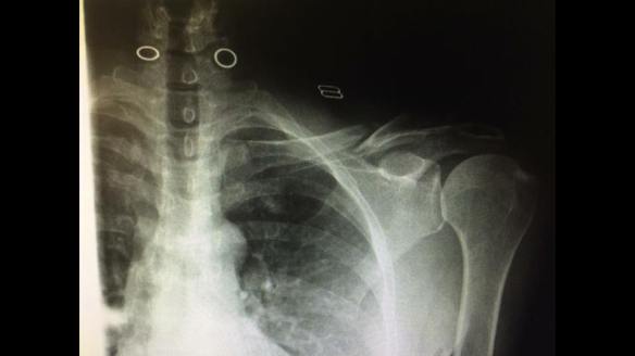 Lori broken clavicle